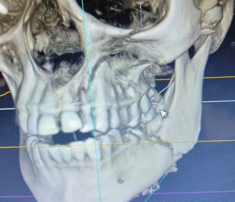 Case 1: jaw cyst before treatment &mdash; Dr. Mahesh Pund