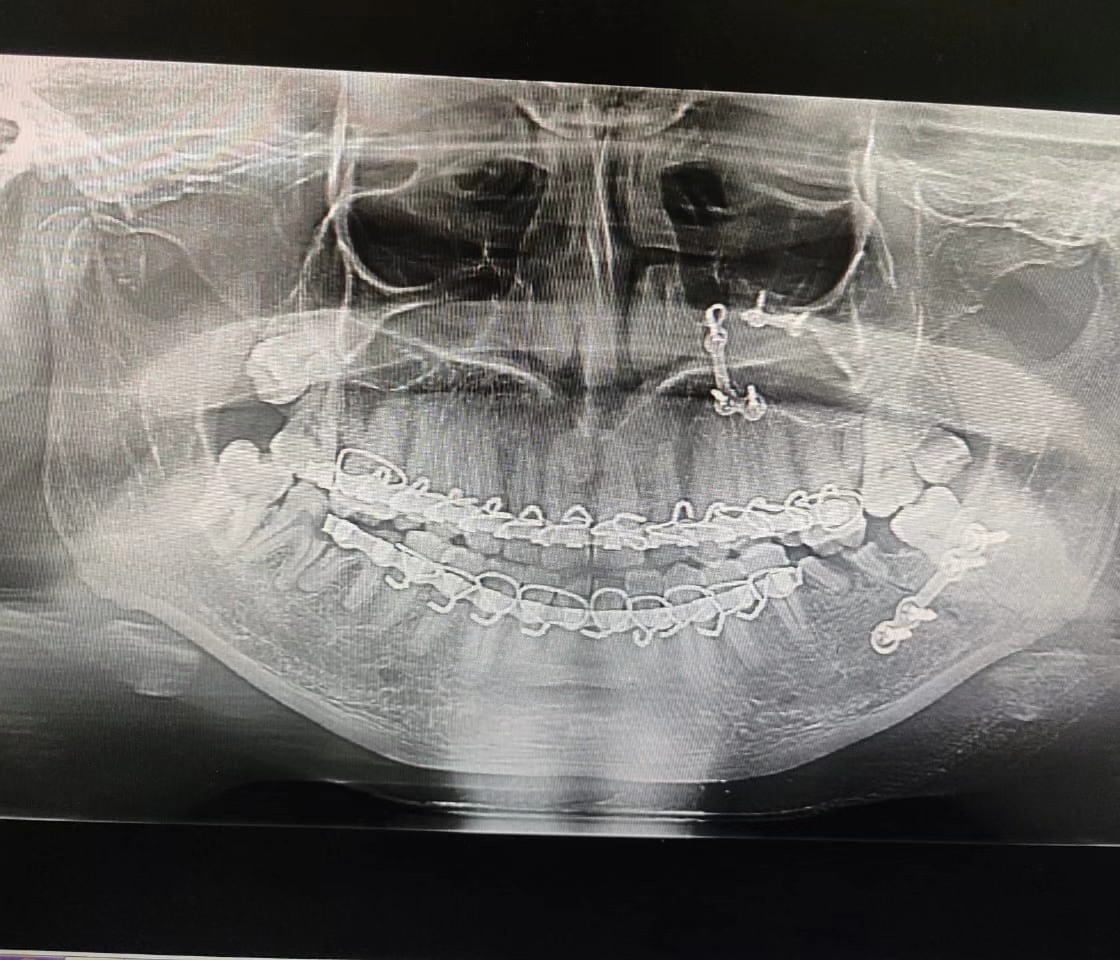Case 1: jaw cyst immediately after surgery &mdash; Dr. Mahesh Pund