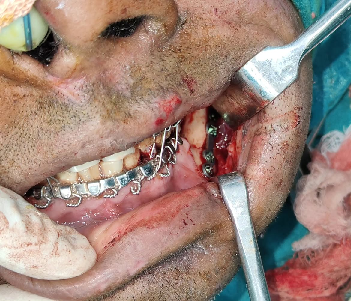 Case 1: jaw cyst during surgery &mdash; Dr. Mahesh Pund