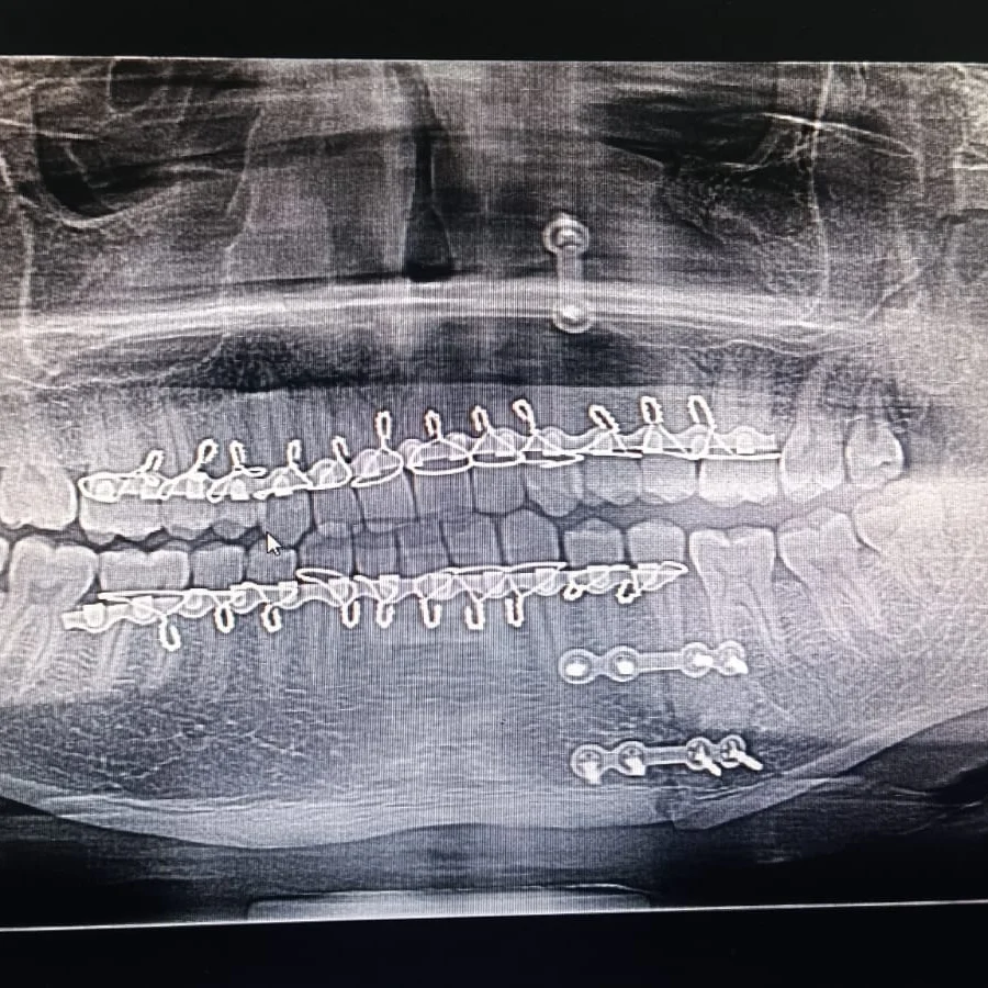Case 2: jaw fracture immediately after surgery &mdash; Dr. Mahesh Pund