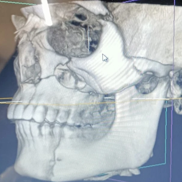 Case 2: jaw fracture before treatment &mdash; Dr. Mahesh Pund