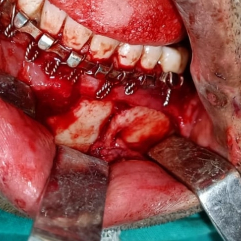 Case 2: jaw fracture during surgery &mdash; Dr. Mahesh Pund