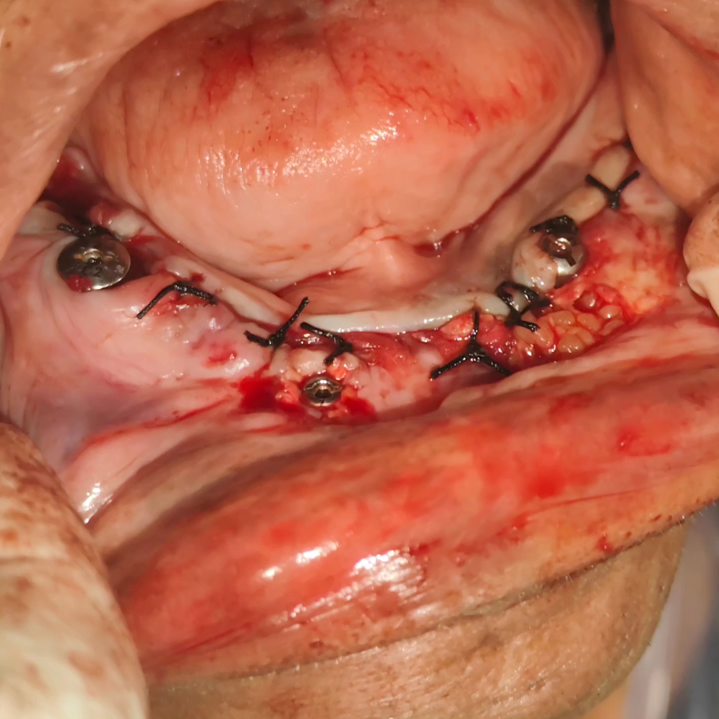 Case 3: implant with bone grafting immediately after surgery &mdash; Dr. Mahesh Pund