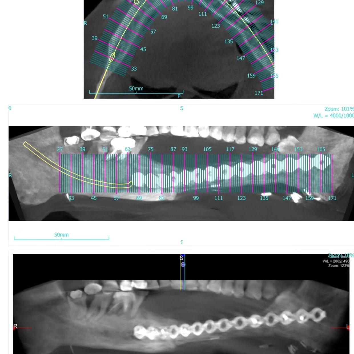 Case 3: implant with bone grafting before treatment &mdash; Dr. Mahesh Pund