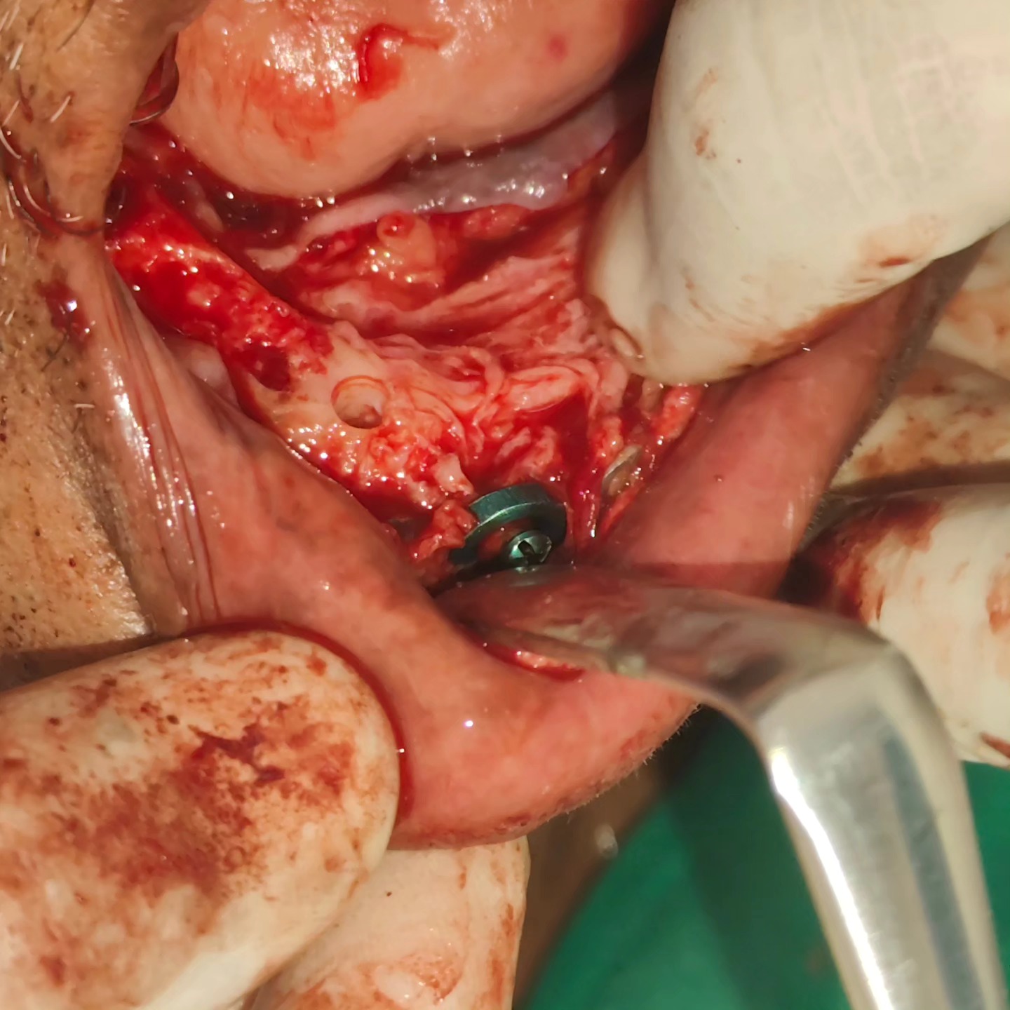 Case 3: implant with bone grafting during surgery &mdash; Dr. Mahesh Pund