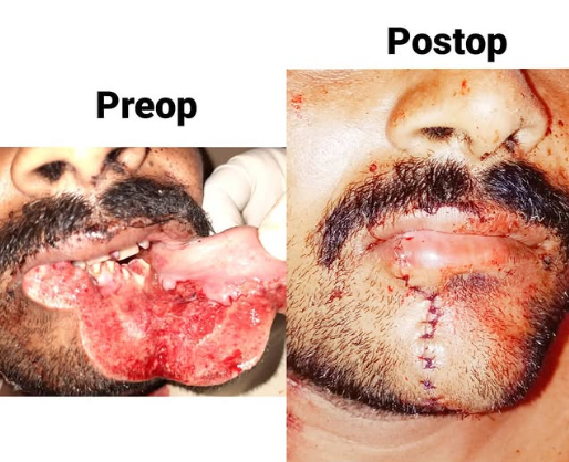 Oral Lesion Removal &mdash; Dr. Mahesh Pund