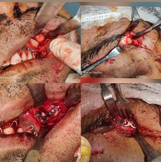 Gummy Smile Correction &mdash; Dr. Mahesh Pund