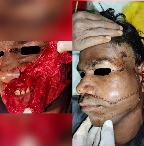 Facial Fracture Fixation &mdash; Dr. Mahesh Pund
