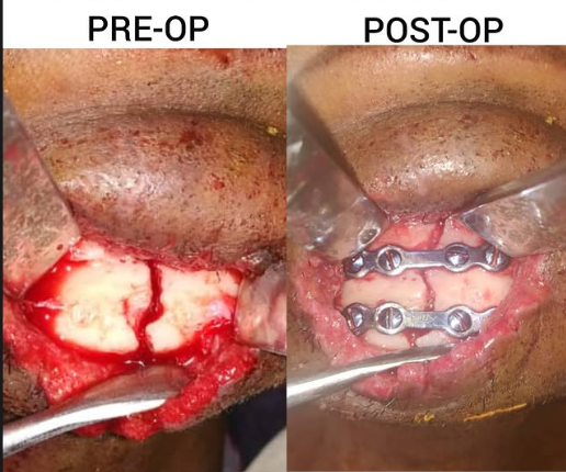 Facial Fracture Fixation &mdash; Dr. Mahesh Pund